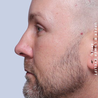 Eyes Before & After Gallery - Patient 407617 - Image 8