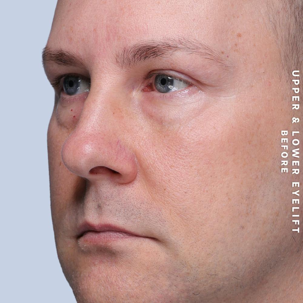 Eyes Before & After Gallery - Patient 407617 - Image 3