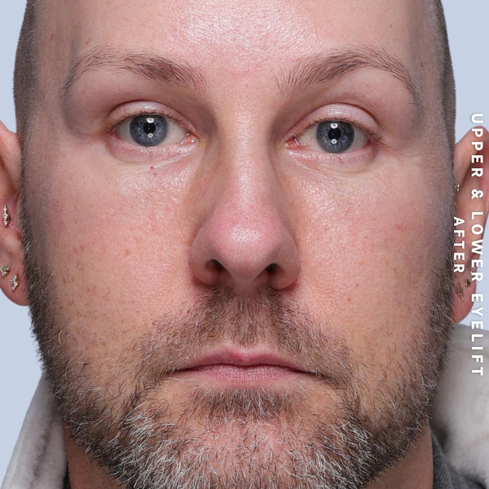 Eyes Before & After Gallery - Patient 407617 - Image 2