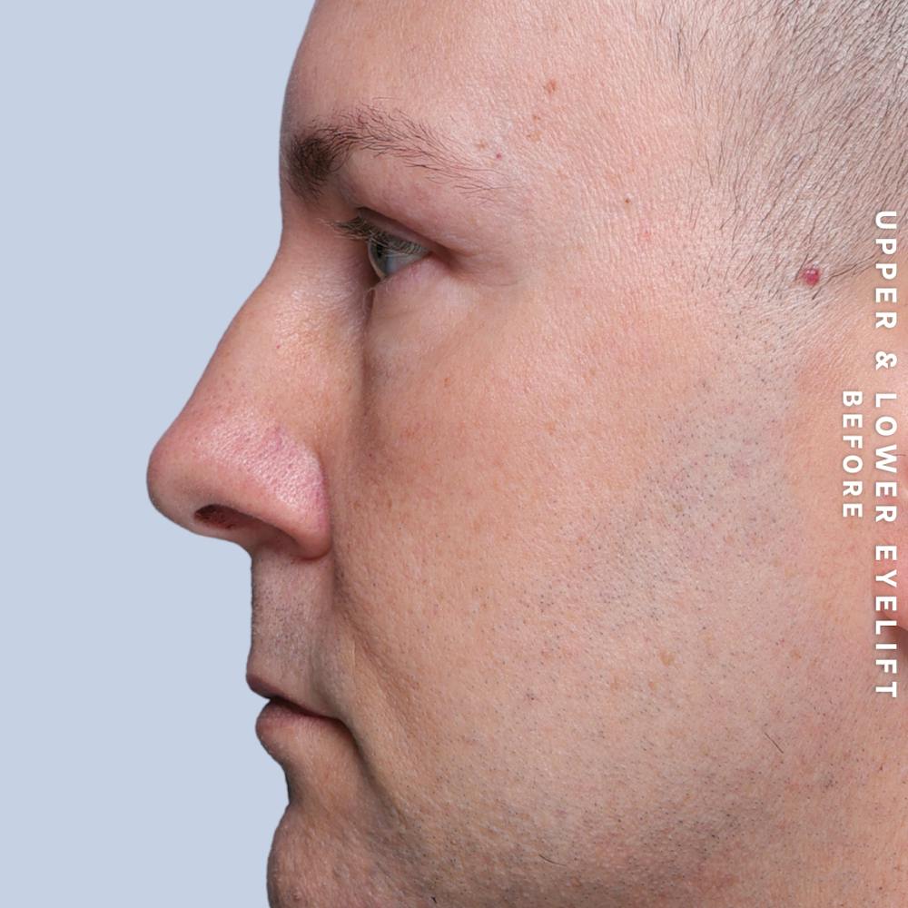 Eyes Before & After Gallery - Patient 407617 - Image 7