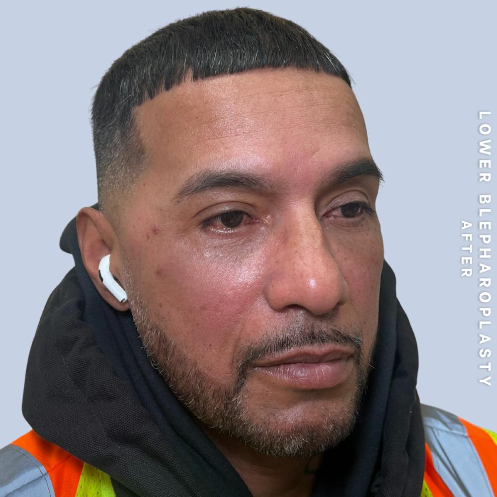 Eyes Before & After Gallery - Patient 248776 - Image 4