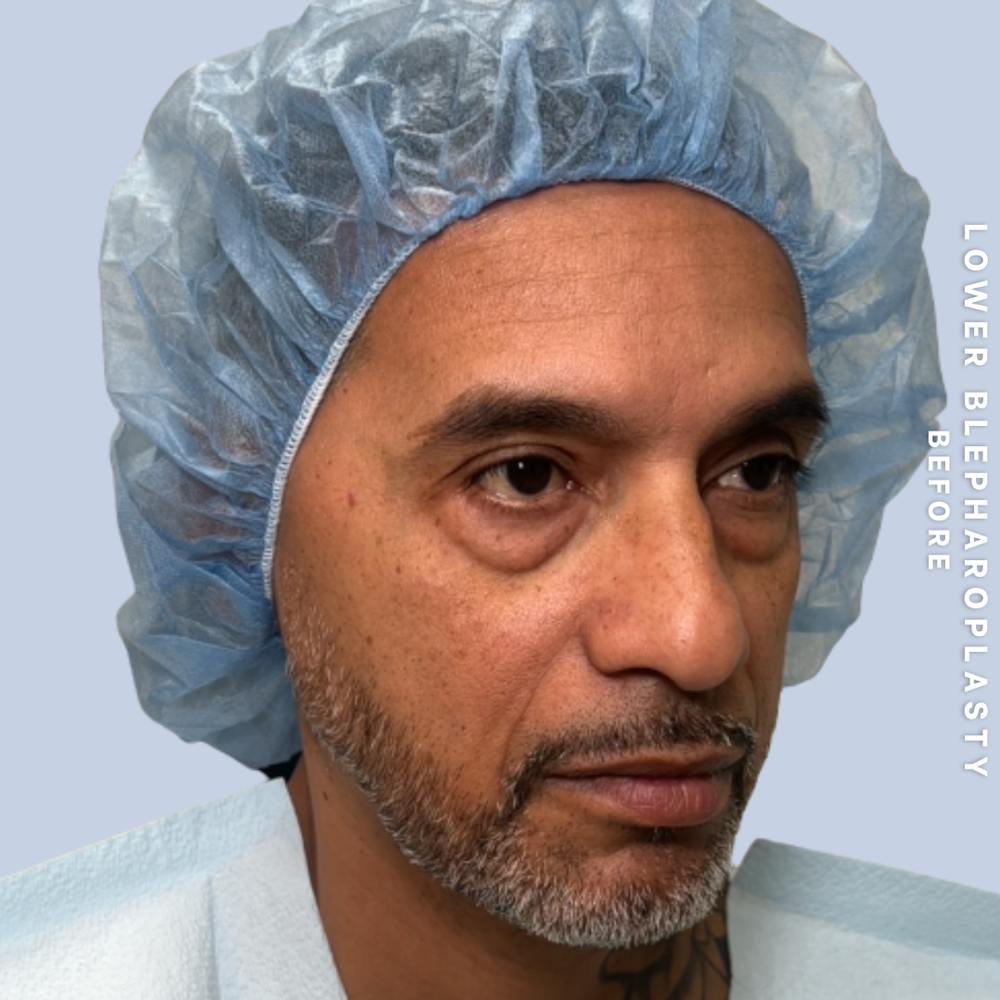 Eyes Before & After Gallery - Patient 248776 - Image 3