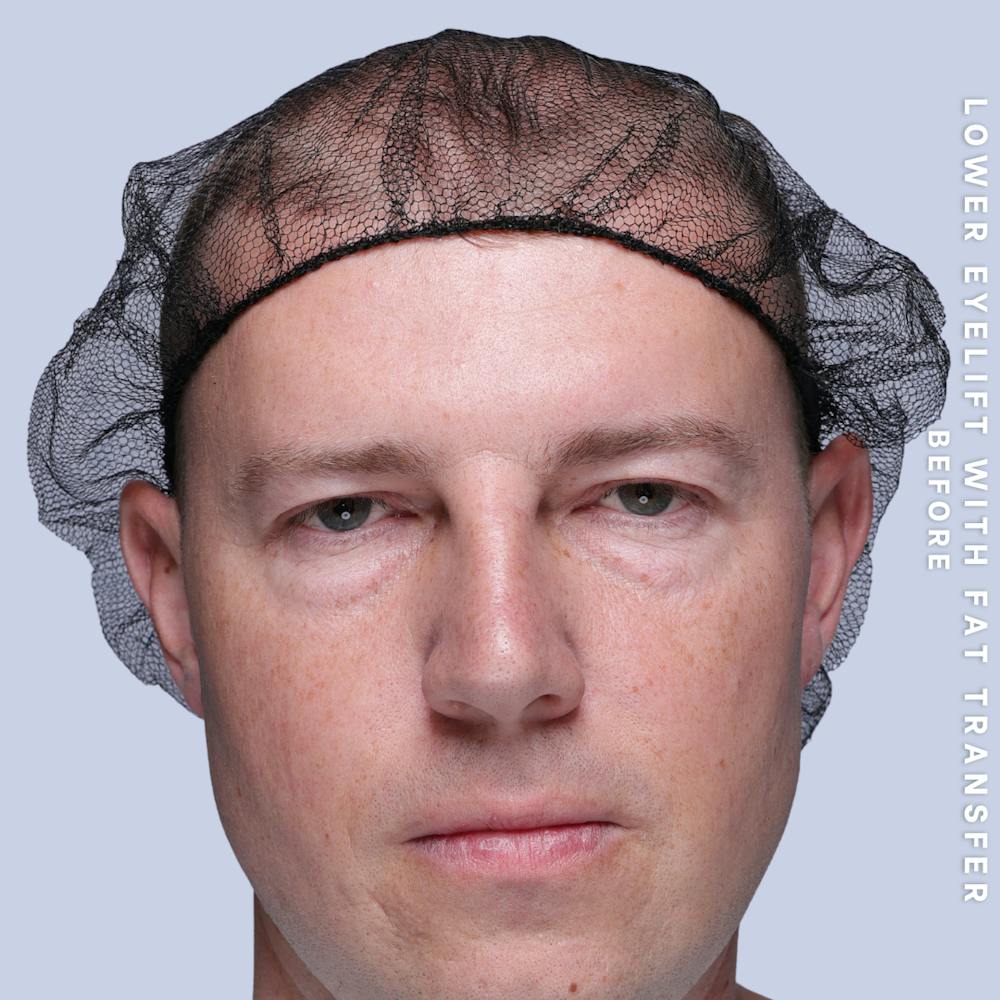 Eyes Before & After Gallery - Patient 118009 - Image 1