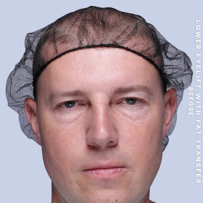 Eyes Before & After Gallery - Patient 118009 - Image 1