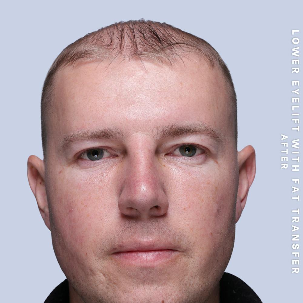 Eyes Before & After Gallery - Patient 118009 - Image 2