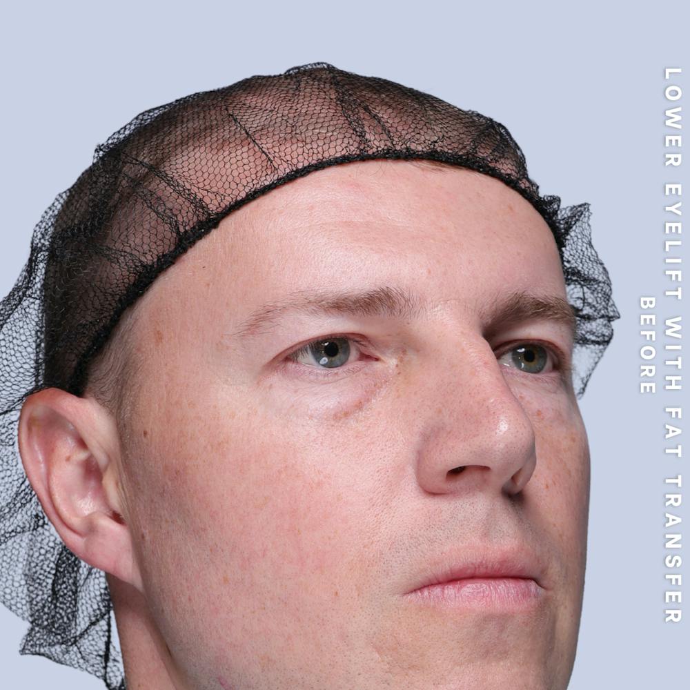 Eyes Before & After Gallery - Patient 118009 - Image 3