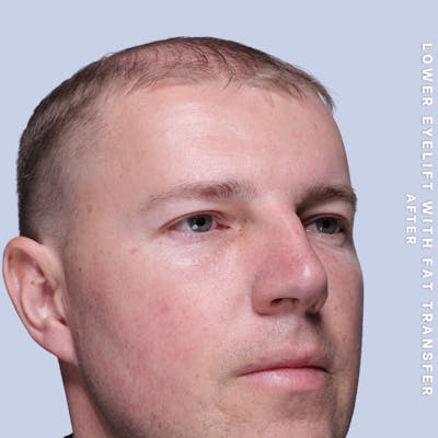 Eyes Before & After Gallery - Patient 118009 - Image 4