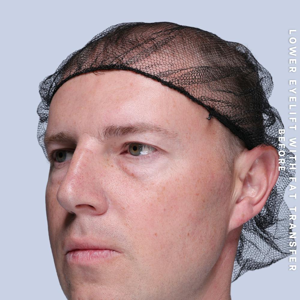 Eyes Before & After Gallery - Patient 118009 - Image 5