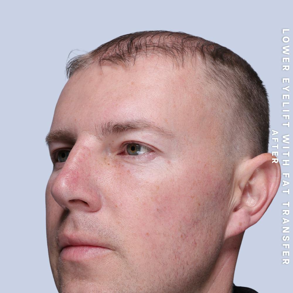 Eyes Before & After Gallery - Patient 118009 - Image 6