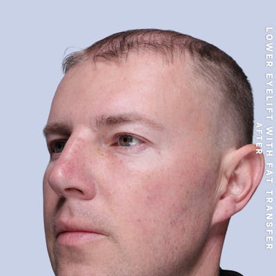 Eyes Before & After Gallery - Patient 118009 - Image 6