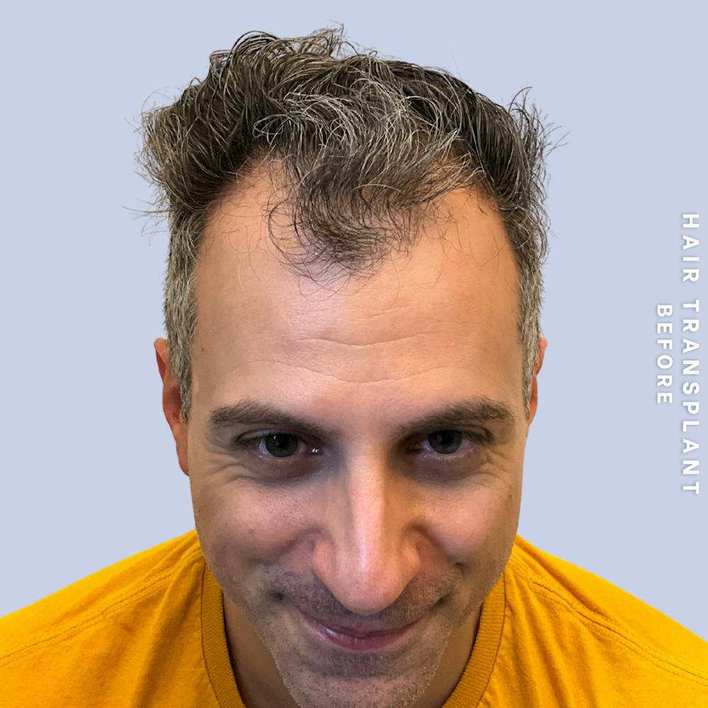 Hair Restoration Before & After Gallery - Patient 650866 - Image 1