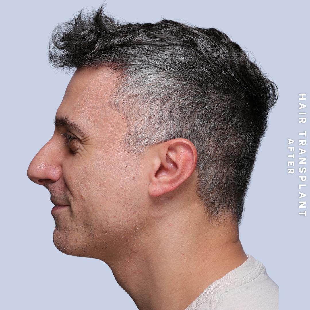Hair Restoration Before & After Gallery - Patient 650866 - Image 12