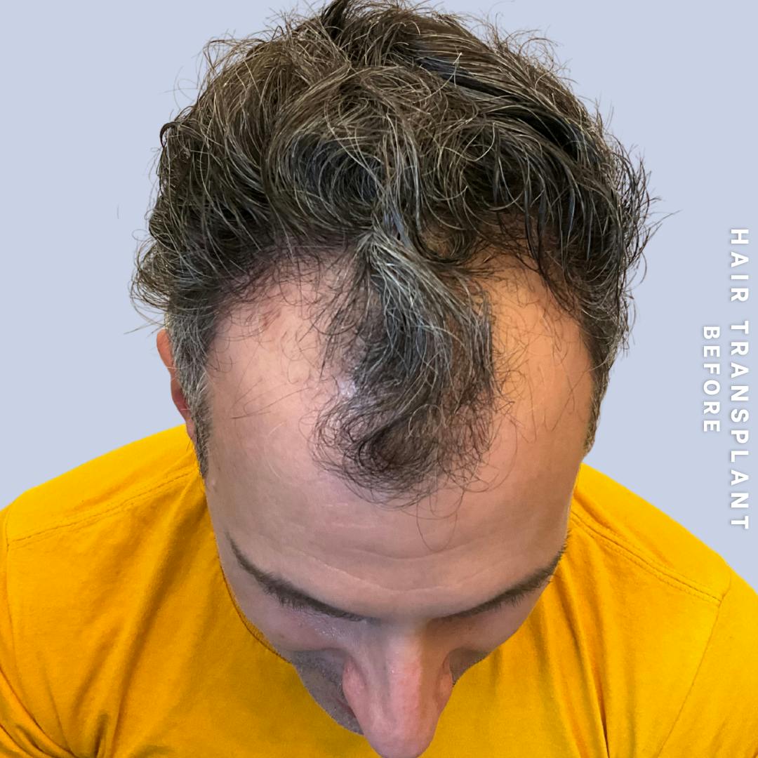 Hair Restoration Before & After Gallery - Patient 650866 - Image 3