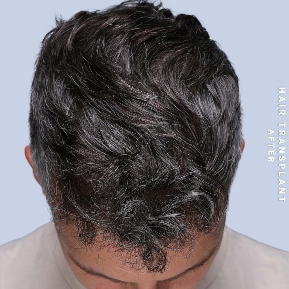 Hair Restoration Before & After Gallery - Patient 650866 - Image 4