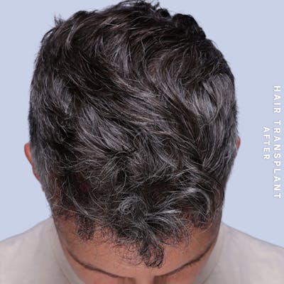 Hair Restoration Before & After Gallery - Patient 650866 - Image 4