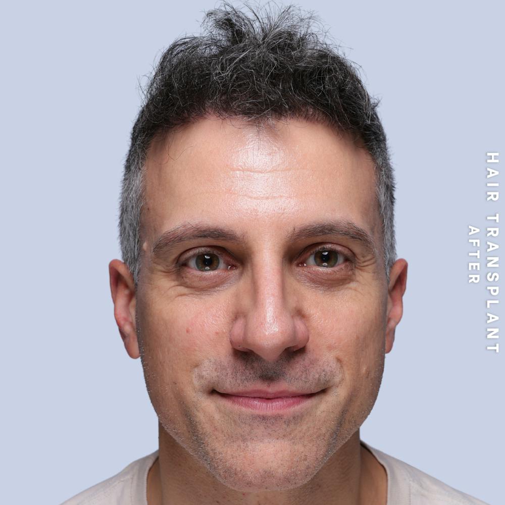 Hair Restoration Before & After Gallery - Patient 650866 - Image 2