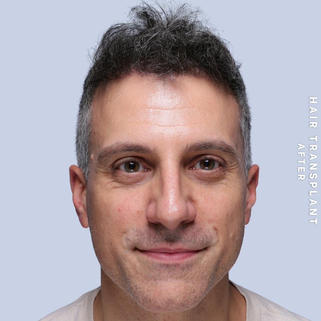 Hair Restoration Before & After Gallery - Patient 650866 - Image 2