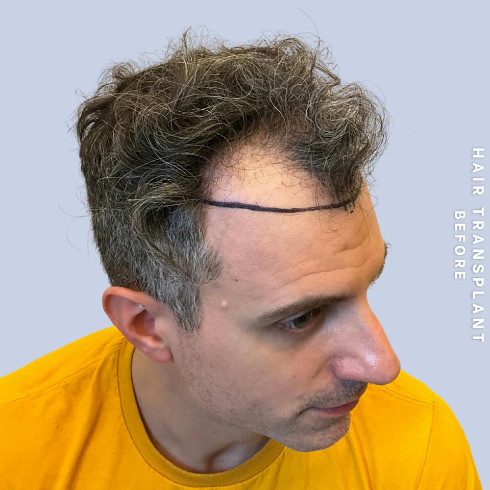 Hair Restoration Before & After Gallery - Patient 650866 - Image 7