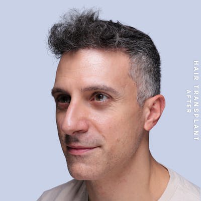 Hair Restoration Before & After Gallery - Patient 650866 - Image 6