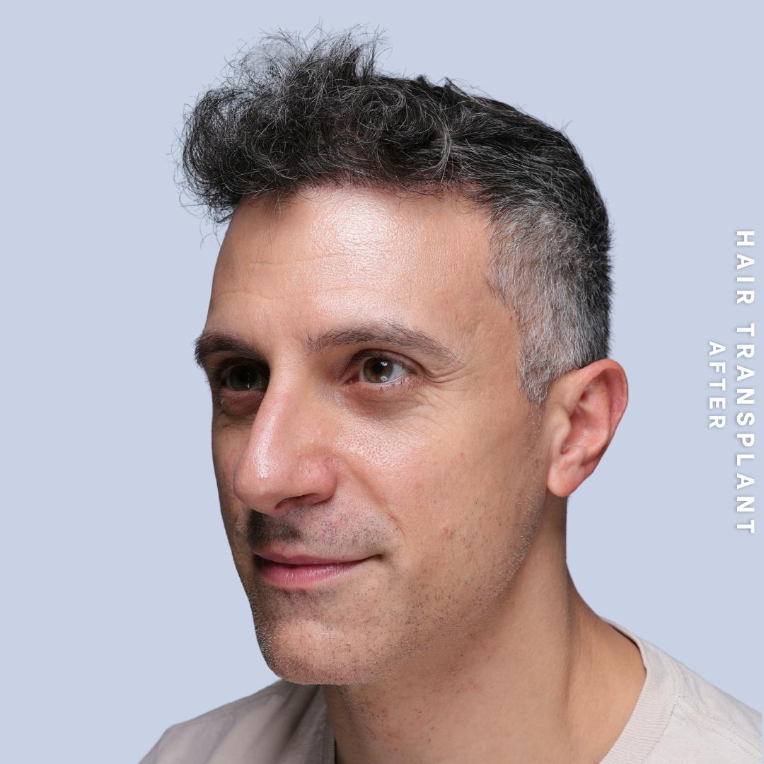 Hair Restoration Before & After Gallery - Patient 650866 - Image 6