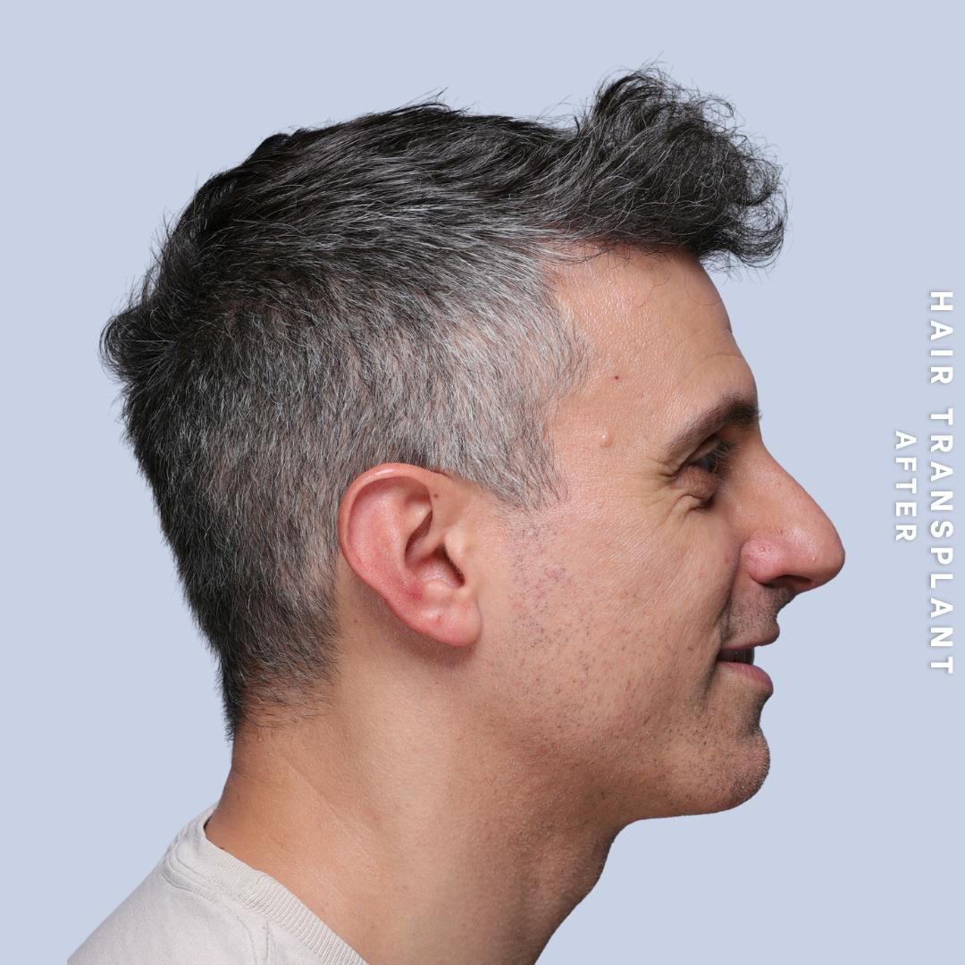 Hair Restoration Before & After Gallery - Patient 650866 - Image 10