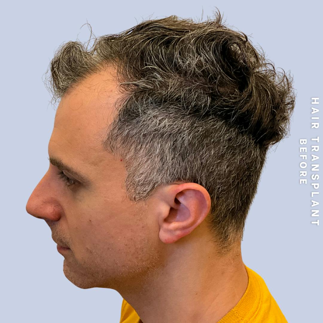 Hair Restoration Before & After Gallery - Patient 650866 - Image 11