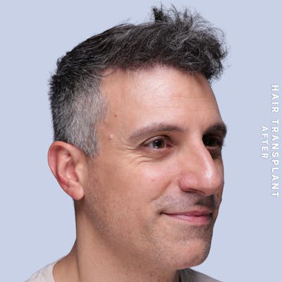 Hair Restoration Before & After Gallery - Patient 650866 - Image 8