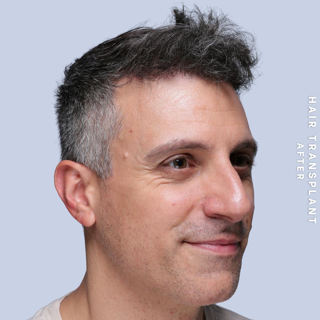 Hair Restoration Before & After Gallery - Patient 650866 - Image 8