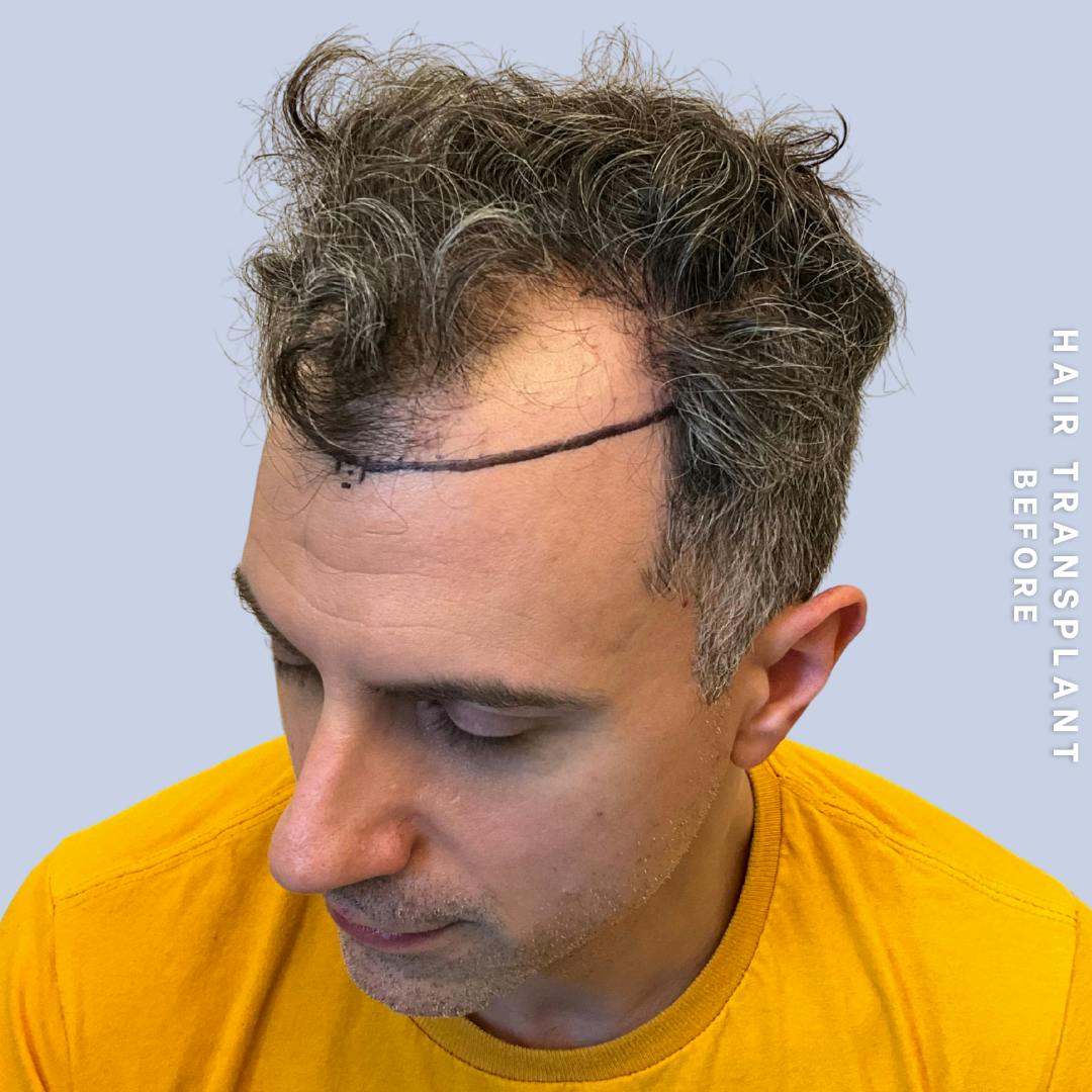 Hair Restoration Before & After Gallery - Patient 650866 - Image 5