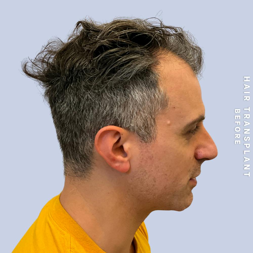 Hair Restoration Before & After Gallery - Patient 650866 - Image 9