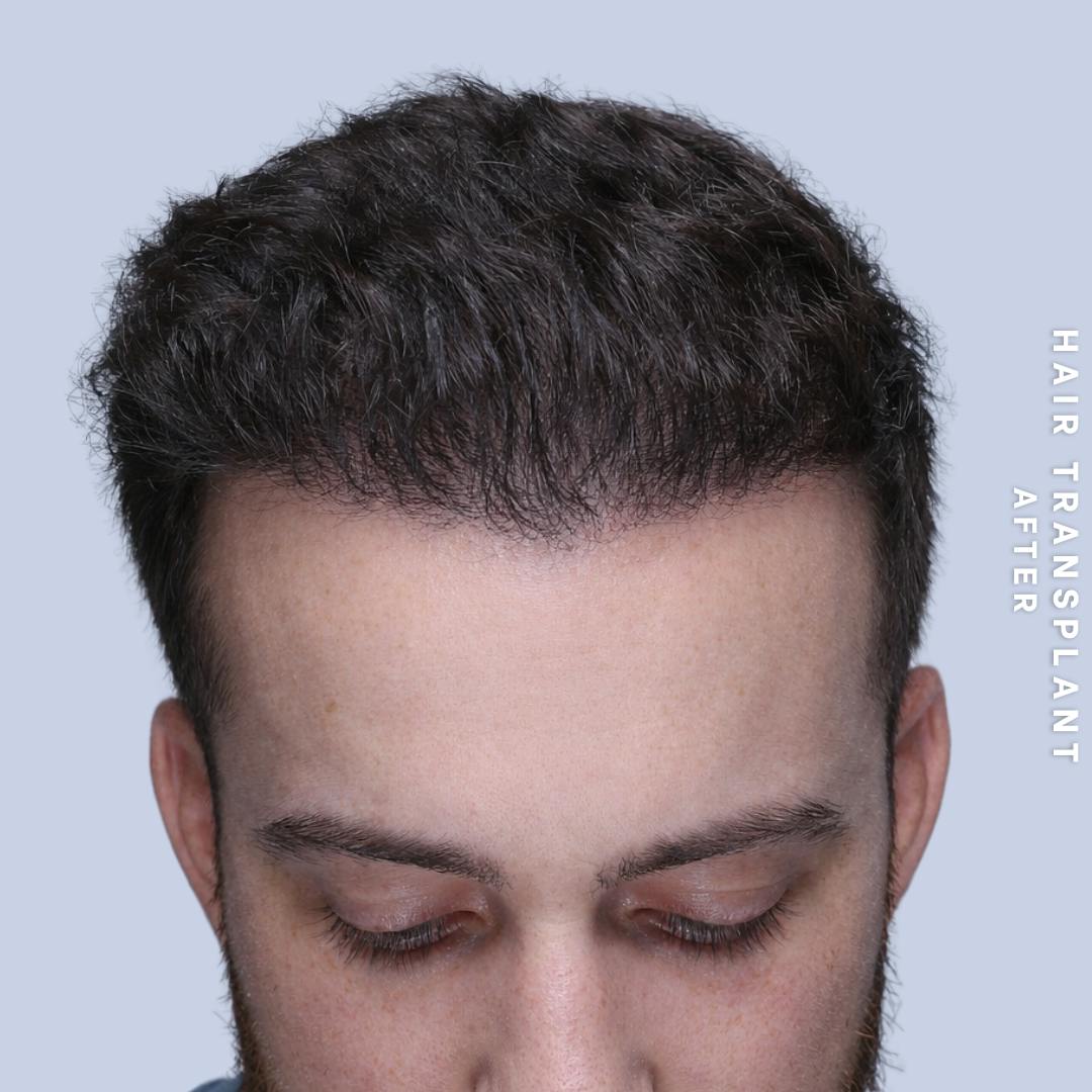 Hair Restoration Before & After Gallery - Patient 140493 - Image 2