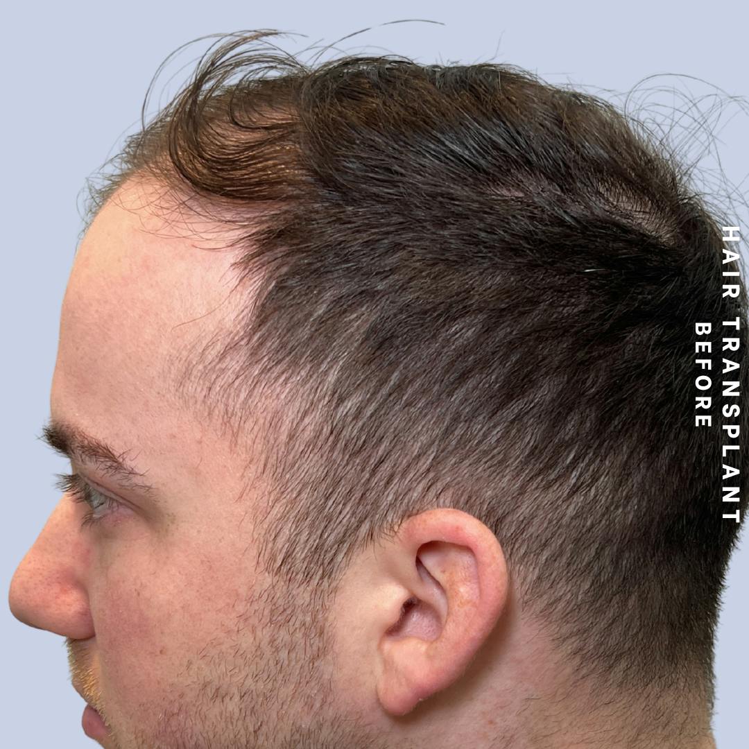 Hair Restoration Before & After Gallery - Patient 140493 - Image 5