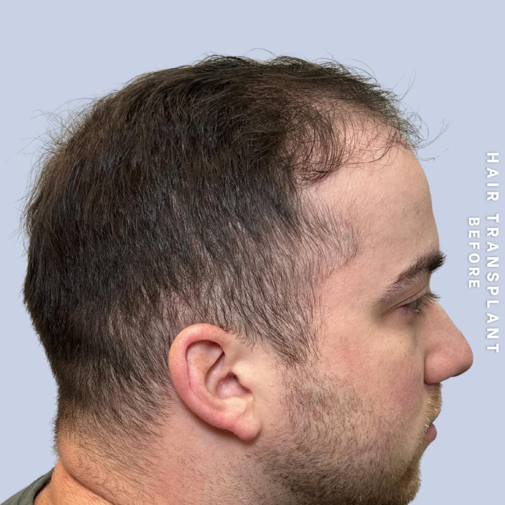 Hair Restoration Before & After Gallery - Patient 140493 - Image 3