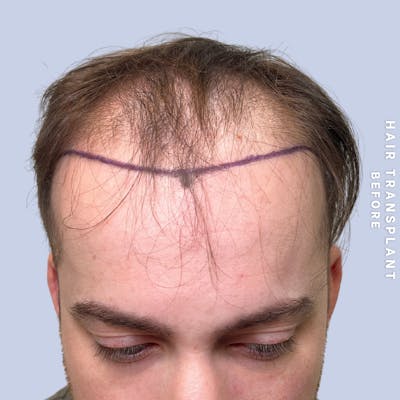 Hair Restoration Before & After Gallery - Patient 140493 - Image 1