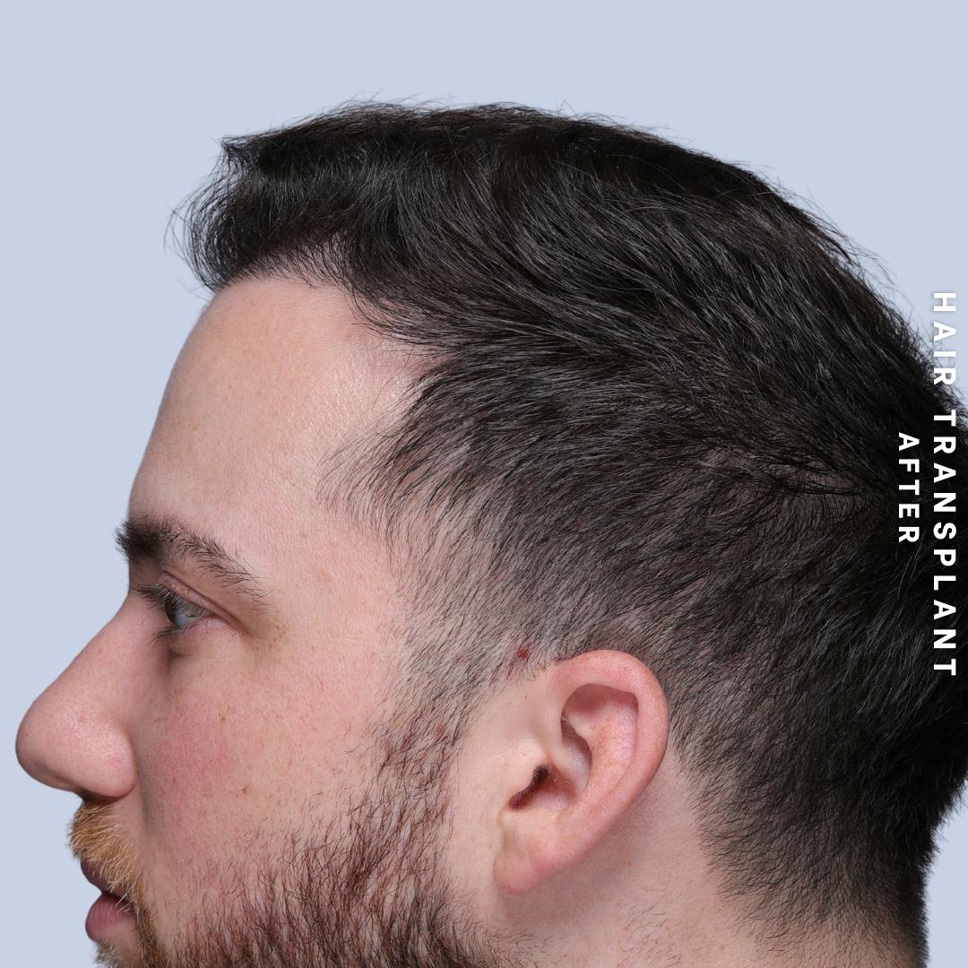 Hair Restoration Before & After Gallery - Patient 140493 - Image 6