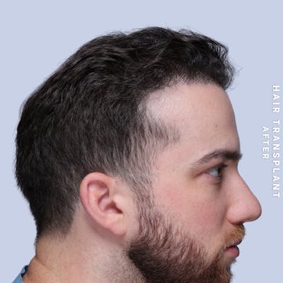 Hair Restoration Before & After Gallery - Patient 140493 - Image 4
