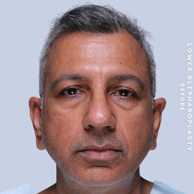 Men's Eyes Before & After Gallery - Patient 124584 - Image 1