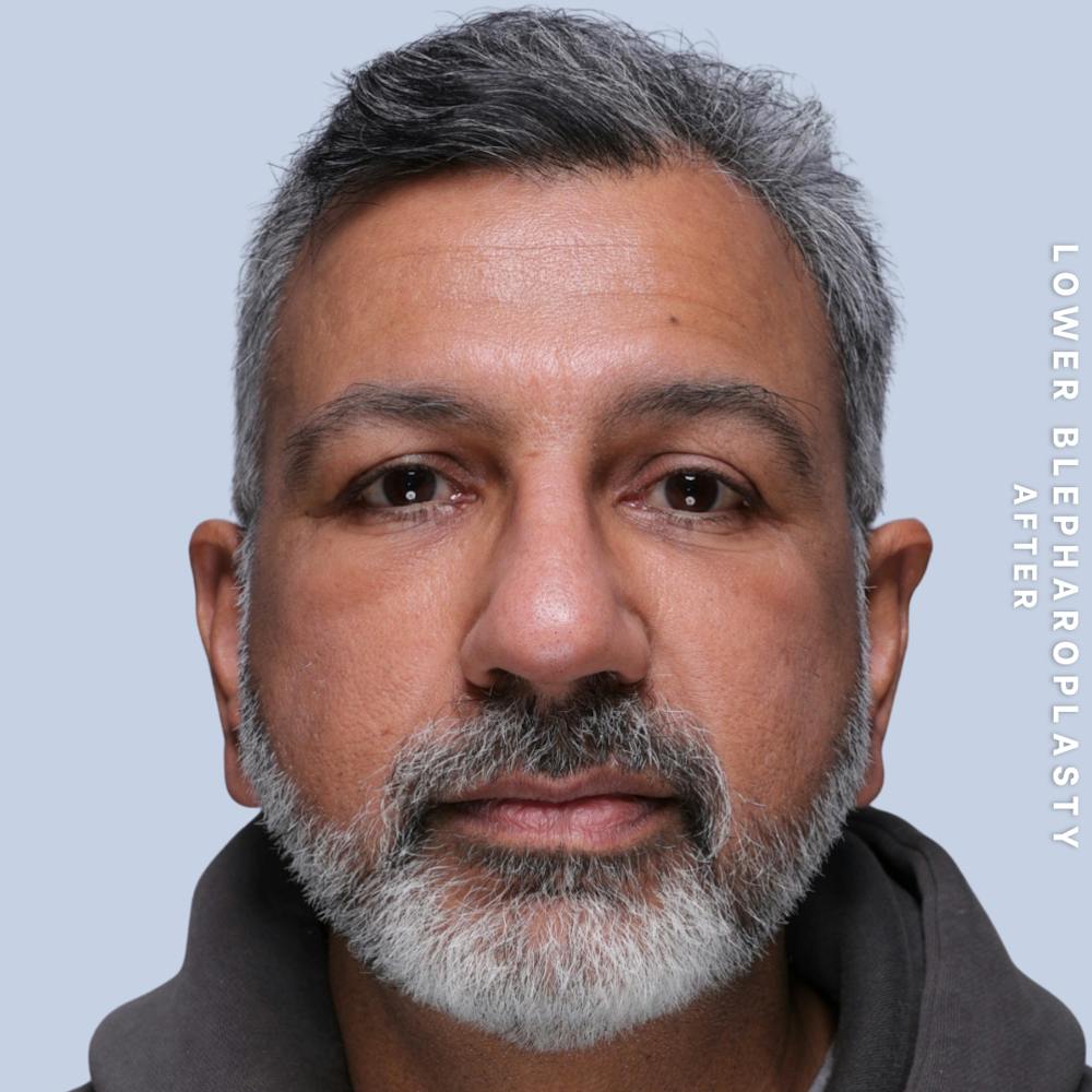 Eyes Before & After Gallery - Patient 323240 - Image 2