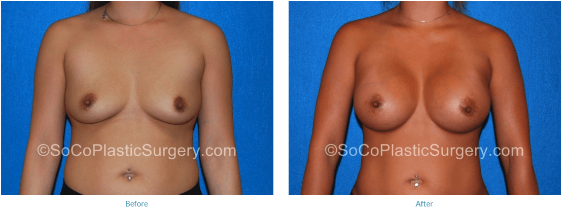 Irvine Breast Augmentation Special - Song Plastic Surgery