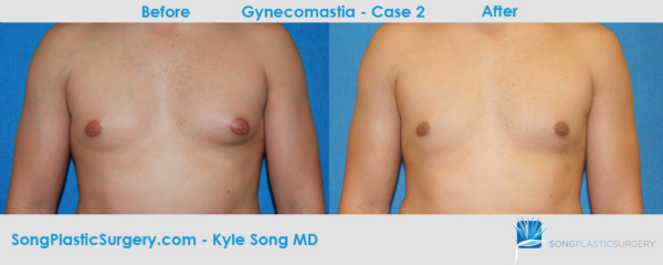 Orange County Male Breast Reduction - Song Plastic Surgery
