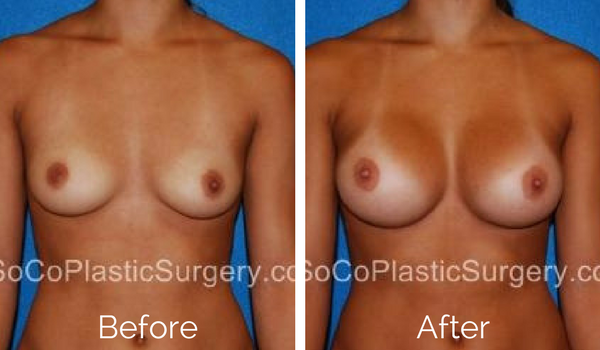 Breast Augmentation Gallery, Irvine