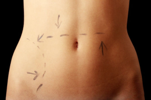 Liposuction vs. -tummy-tuck Irvine