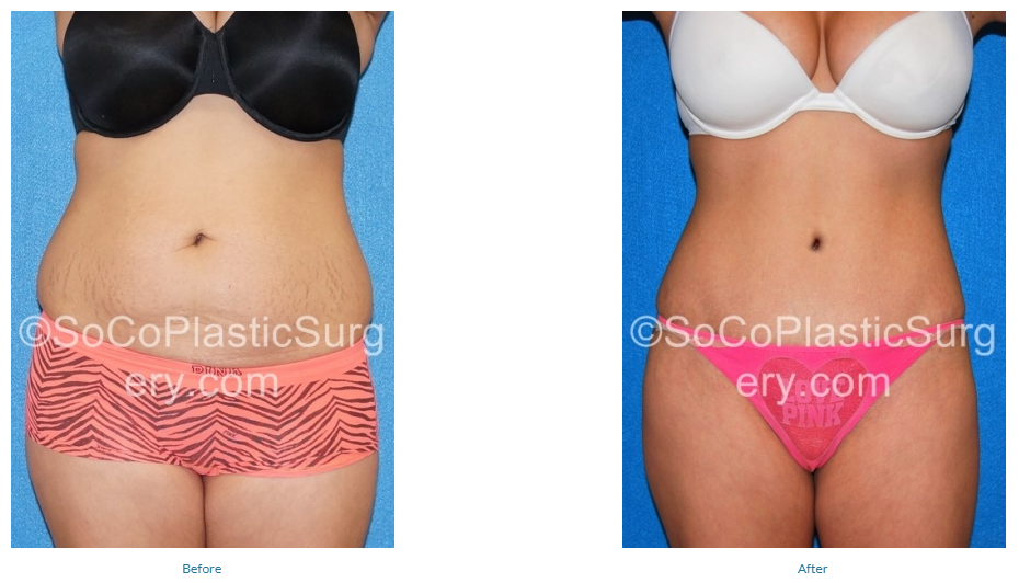 Tummy Tuck Recovery Time Irvine, Tummy Tuck Orange County