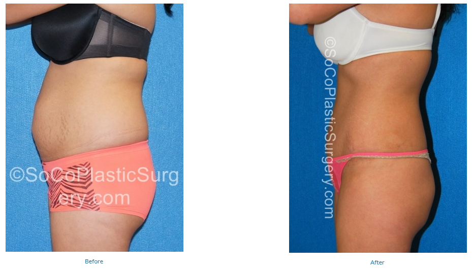 Liposuction vs. SculpSure Orange County, Body Contouring Irvine, CA