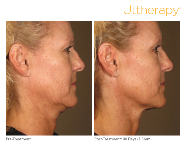 Ultherapy Results Irvine