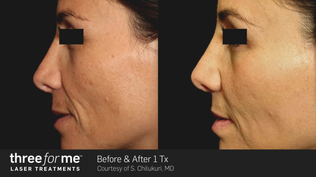 ThreeForMe-Before-After-S.-Chilukuri-1Tx-Newport Beach