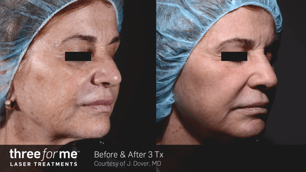 ThreeForMe-Before-After-J.-Dover-3Tx-Irvine