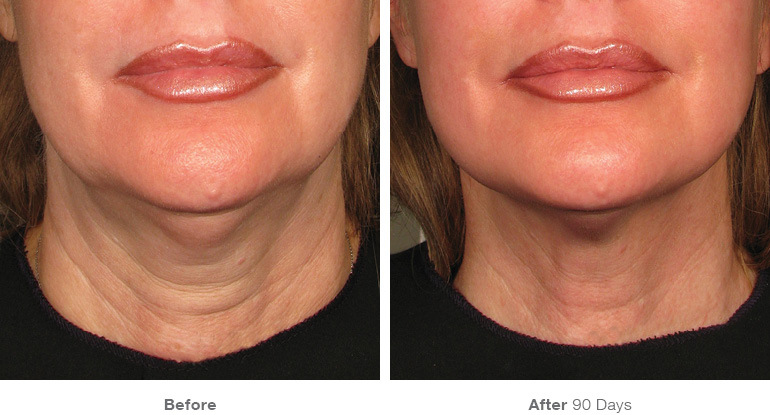 Ultherapy Results Irvine