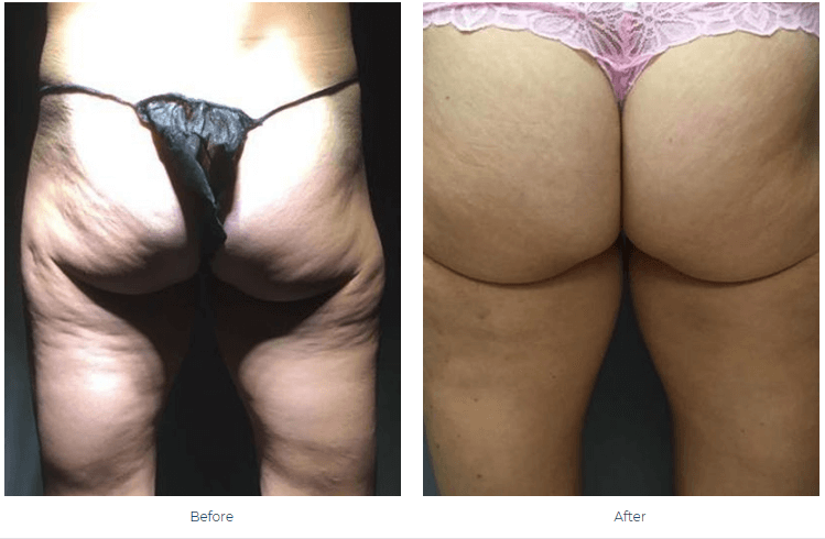 Once Cellulite Has Been Removed, Can It Return Newport Beach