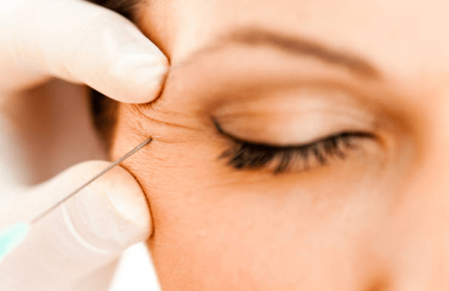 Botox Irvine Botox Irvine